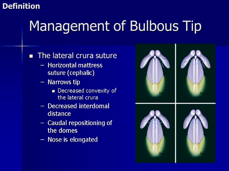 Management of Bulbous Tip The lateral crura suture Horizontal mattress suture (cephalic) Narrows tip